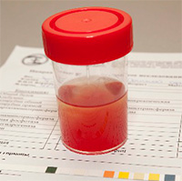 Кровь в моче